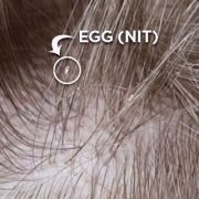 lice nit (egg) in hair