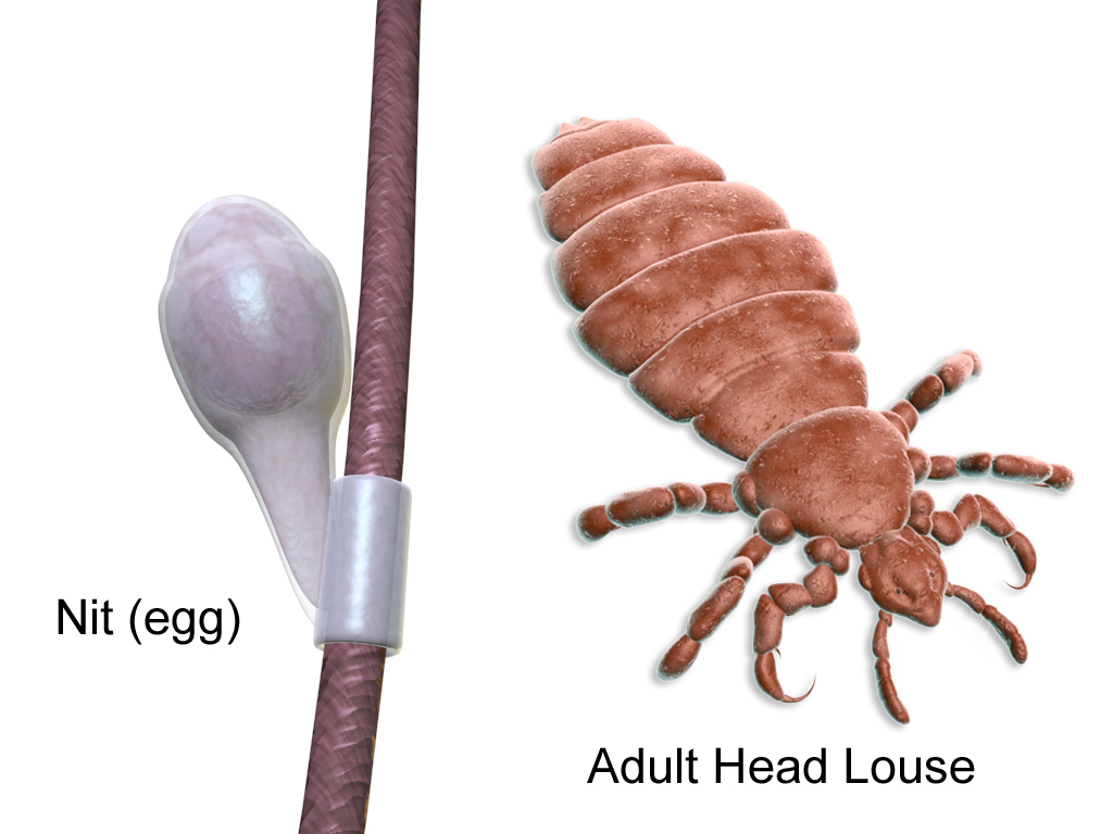 Helpful Tips on How to Prevent Lice & Eggs | LCA - Puget Sound